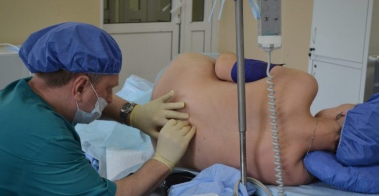 epidural